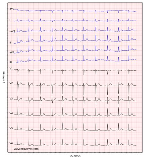 what does a normal ecg look like.